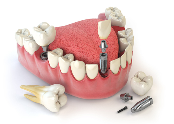 Протезирование зубов в стоматологической клинике Novaproff